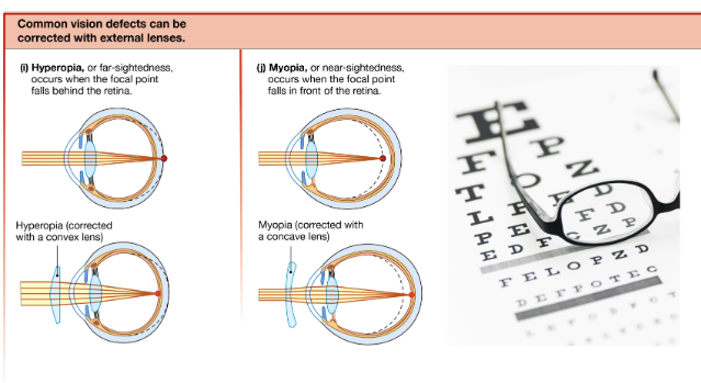 <p>Two other common vision problems are near-sightedness and far-sightedness. Near-sightedness, or <strong>myopia</strong>, occurs when the focal point falls in front of the retina (Fig. 11.26j). Far-sightedness, or <strong>hyperopia</strong>, occurs when the focal point falls behind the retina (Fig. 11.26i). </p>