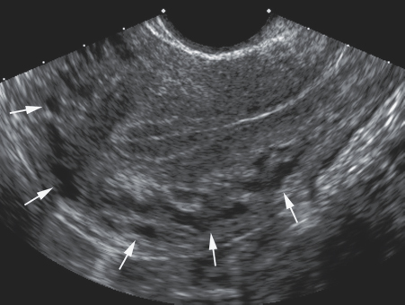 <p>5. What do the arrows in Figure 16-16 indicate?</p><p>a. Radial arteries</p><p>b. Uterine arteries</p><p>c. Spiral arteries</p><p>d. Arcuate arteries</p>