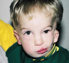 <p>Hemifacial microsomia which is believed to be a disorder of the dysfunction of the stapeidal artery during embryonic development. Etiology is unknown but not believed to be genetic. In addition to facial asymmetry: facial nerve palsy, ear tags, macrostomia, CL/P, benign eye tumor, cardiac / renal / radial ray anomalies.</p>