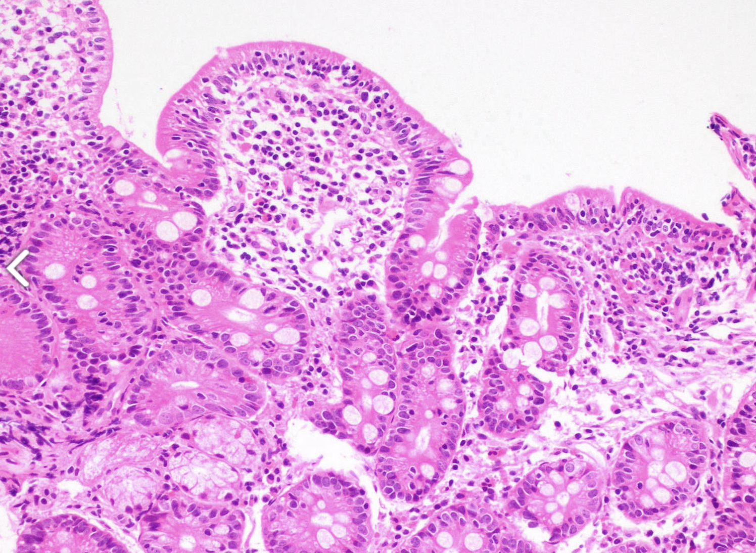 <p>Jeune femme avec malabsorption. Biopsie duodenale </p><p>1) Diagnostic</p><p>2) population</p><p>3) sérologies</p><p>4) fond génétique </p>