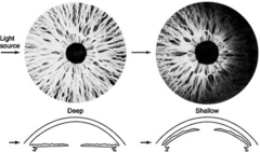 <p>shine pen light from temporal side of each eye at a 90 degree angle. evaluate for a crescentic shadow on the medial side of the iris?</p><p>normal: flat iris results in an open angle of the cornea causes full illumination.</p><p>abnormal: bowing abnormality of the iris forming a narrow angle with cornea creating a crescentic shadow</p>