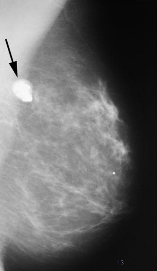 <ul><li><p>Fibrous non-cancerous solid growth </p></li><li><p>Painless</p></li><li><p>Smooth wall</p></li><li><p>Common </p></li></ul><p></p>