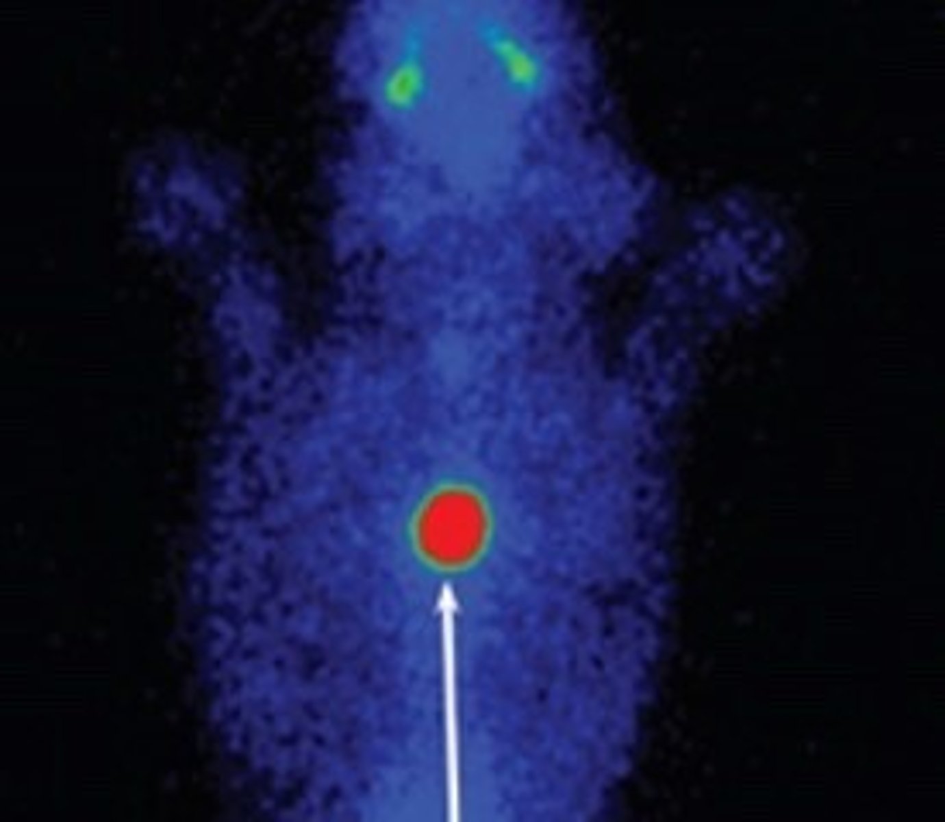<p>ectopic thyroid adenoma</p>