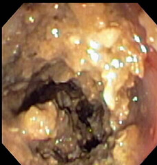 <p>What is this being used to diagnose, showing you white mats, plaques, or granulomas which need to be debulked prior to treatment?</p>