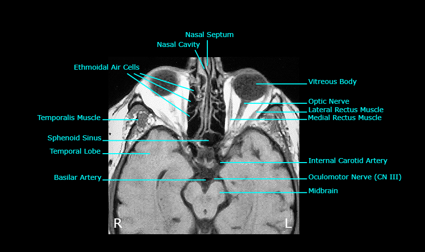 <ol><li><p>Nasal Septum</p></li><li><p>Nasal Cavity</p></li><li><p>Ethmoidal Sinus</p></li><li><p>Temporalis Muscle</p></li><li><p>Sphenoid Sinus</p></li><li><p>Temporal Lobe</p></li><li><p>Basilar Artery</p></li><li><p>Midbrain</p></li><li><p>Oculomotor Nerve (CN III)</p></li><li><p>Internal Carotid Artery</p></li><li><p>Medial Rectus Muscle</p></li><li><p>Lateral Rectus Muscle</p></li><li><p>Optic Nerve</p></li><li><p>Vitreous Body</p></li></ol><p></p>