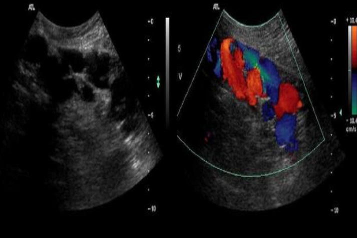 <p>long images of the anterior abdomen just superior to the umbilicus. What is the most common cause of the abnormality seen on the images?</p>