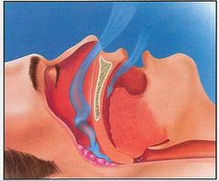 <p>Repeated interruptions of breathing during sleep that disrupt normal sleep.</p>