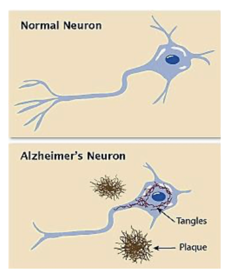 <p>accumulation of brain pathology with age </p><ul><li><p>amyloid or neuritic plaques (NP)</p></li><li><p>neurofibrillary tangles (NFT)</p></li></ul><p></p>