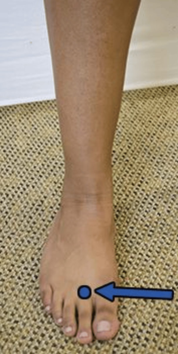 <p>2,4</p><p>1. A diminished knee reflex is indicative of a herniated disc at the L4 level, which would not be consistent with the symptoms reported by the patient</p><p>2. A diminished ankle reflex is indicative of a herniated disc at the S1 level, which would not be consistent with the symptoms reported by the patient</p><p>3. A weak gastrocnemius is indicative of a herniated disc at the S1 level, which would not be consistent with the symptoms reported by the patient</p><p>4. The patient's symptoms are indicative of a herniated disc at the L5 level, which causes compression of the 5th lumbar nerve root. Sensory deficits extend on the dorsolateral foot as indicated in the photograph. Subsequent motor weakness involves the extensor hallucis longus</p>