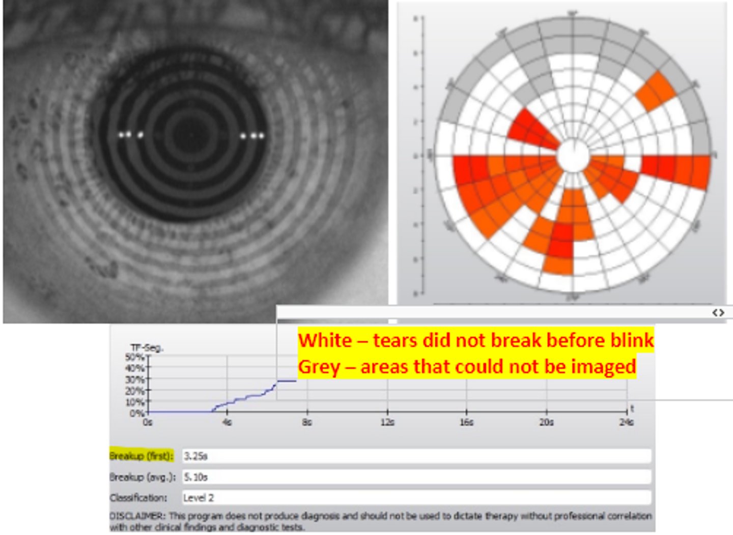 <p>device that images the cornea with infrared light to reduce reflex tearing and stimulation of early blink due to brightness discomfort. Recording of the mires begins after two blinks then stops after the third while the patient focuses straight ahead.</p>