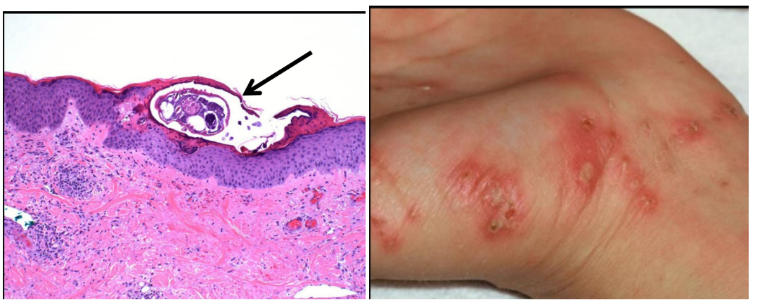 <p>Identifique a parasitose e explique esse sinal clínico</p>