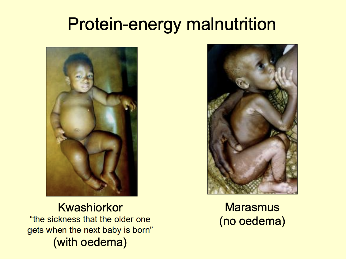 <ul><li><p>Protein deficieny</p></li><li><p>despire sufficient calorie intake</p></li></ul><p></p>