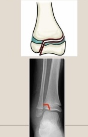 <p>Use the Salter-Harris classification system to describe the fracture pattern</p>