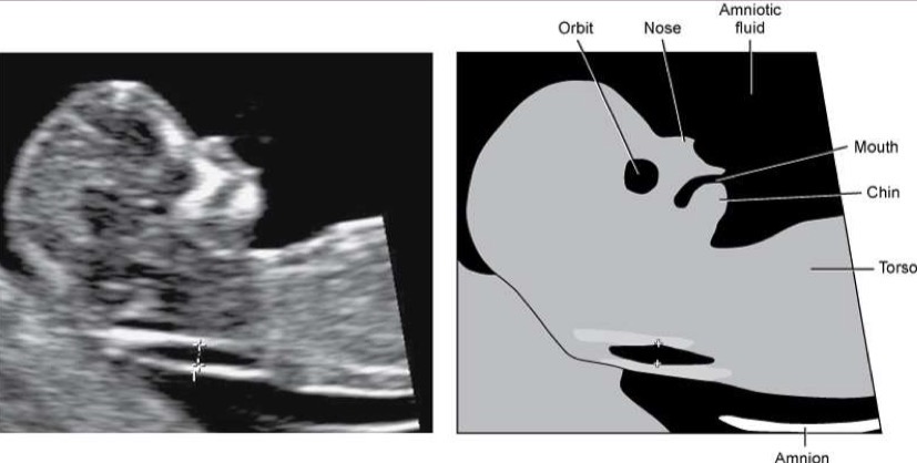 <p>Used in combination with maternal serum screen (blood test) and maternal age to determine fetal risk; fluid that normally collects at back of fetus’s neck between 11.3-13.6 weeks of gestation; head should not be flexed or extended; spinal column should face bottom of imaging screen; calipers must be placed on inner borders of widest portion of NT (if NT is too large, could indicate to chromosomal abnormalities)</p>