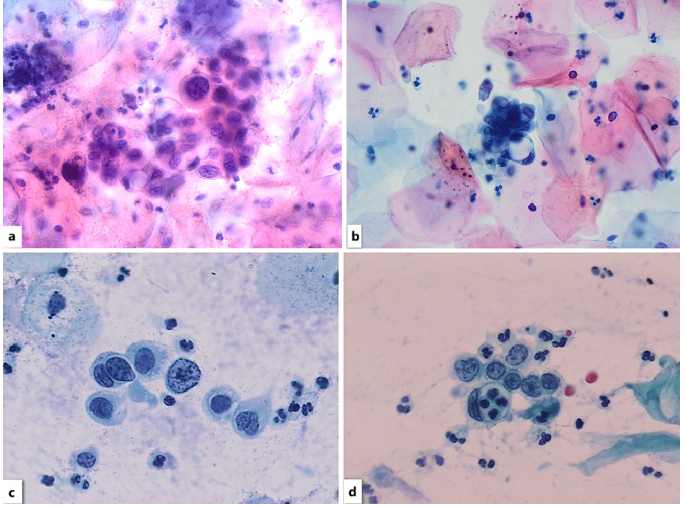 <p>effet DIU (a et b)</p><p>1)</p><ul><li><p>cellules larges vacuolisées, pseudo-signet ring (photos)</p></li></ul><ul><li><p>Petites cellules à gros noyau</p></li><li><p>Nucléoles</p></li><li><p>chromatine dense</p></li></ul><p></p><p>2) (c et d)</p><p>HSIL</p><ul><li><p>Chromatine grossière</p></li><li><p>Pas de nucléoles</p></li><li><p>contours irréguliers</p></li></ul><p></p><p>Adénocarcinome</p><ul><li><p>3D</p></li><li><p>Tumor diathesis</p></li></ul><p></p>