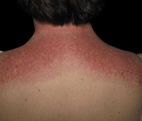 <p>What skin presentation caused by dermatomyositis is shown here?</p>