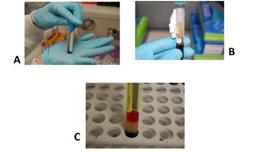 <p>Which is the hemolyzed specimen? </p>