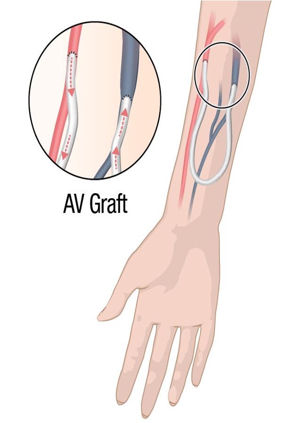 <p>CKD - arteriovenous graft - vascular access </p>
