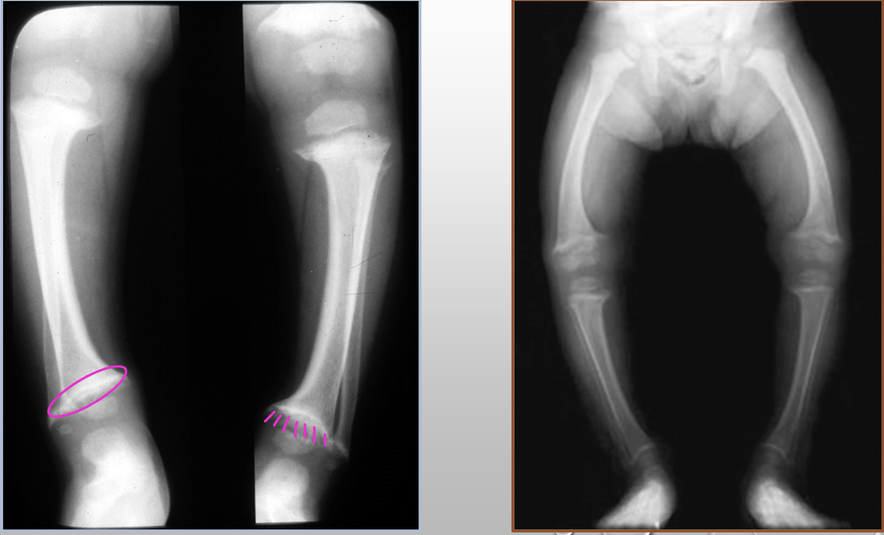<p>What two radiographic findings are in this image of Rickets</p>