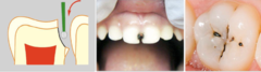 <p>-Black staining (ONLY on demineralized area, not on sound enamel) </p><p>-discolors the soft tissue as well - temporarily </p><p>-mucosal irritation</p>