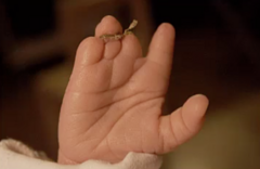 <p>- Fetal structures are entrapped by fibrous bands in utero, often involving limbs/digits</p><p>- Babies born with short fingers and toes</p>