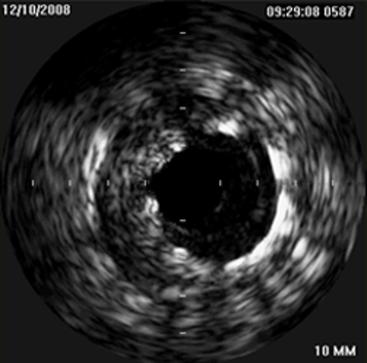 <p>This stent is not fully apposed</p>