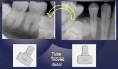 <p>Is the impacted tooth buccal or lingual?</p>