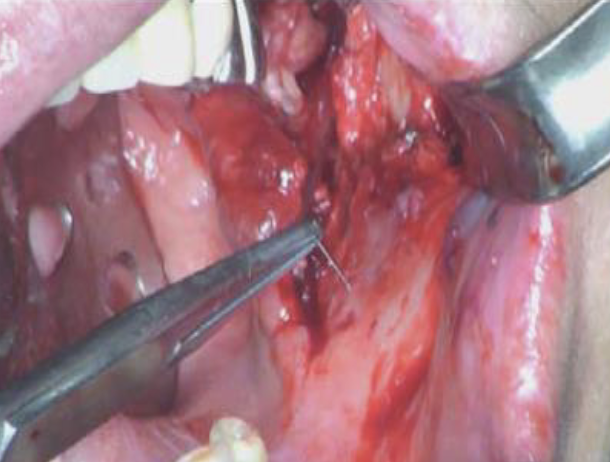 <p><strong>Complication</strong> – The needle breaks while administering local anesthetic to your pt</p>