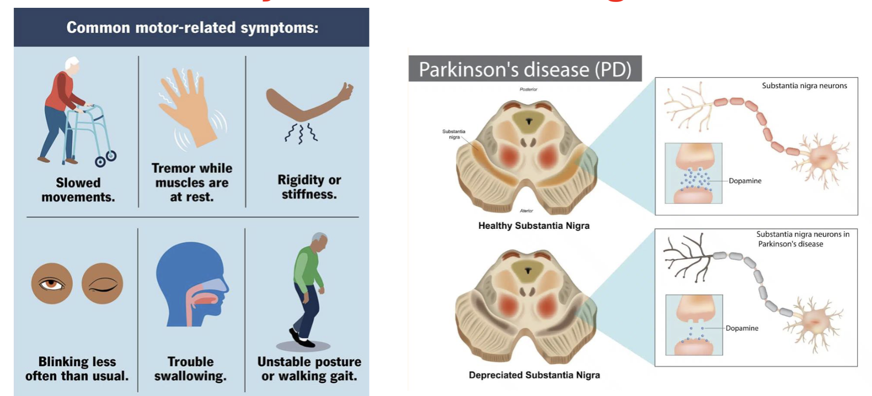 <p>PD caused by selective neurodegeneration → cell replacement therapy could be promising; ex: allogenic treatment (bemdaneprocel cell therapy)</p>