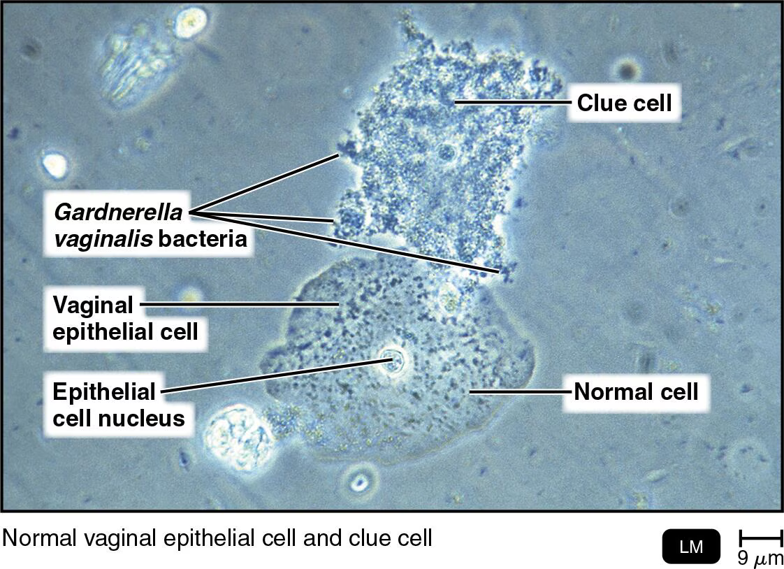<ul><li><p><span style="font-size: calc(var(--scale-factor)*10.00px);">Caused by Gardnerella vaginalis or Candida albicans</span></p></li><li><p><span style="font-size: calc(var(--scale-factor)*10.00px);">Often precipitated by a decrease in the number of Lactobacillus</span></p></li><li><p><span style="font-size: calc(var(--scale-factor)*10.00px);">pH above 4.5, fishy odor, copious frothy discharge</span></p></li><li><p><span style="font-size: calc(var(--scale-factor)*10.00px);">Clue cells in discharge</span></p></li></ul><p></p>