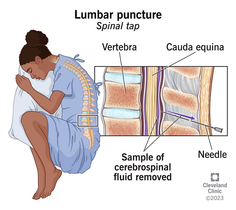 <p><span>A </span><strong>spinal tap</strong><span>, also called a </span><strong>lumbar puncture (LP)</strong><span>, is a medical procedure in which a needle is inserted into the lower back, into the space between two lumbar vertebrae, to collect a small sample of </span><strong>cerebrospinal fluid (CSF)</strong><span> for testing or to measure its pressure</span></p><p><span>low risk, cause needle cant reach spinal code, the needle is made to be less trauma into the back.</span></p>