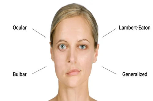 <ul><li><p>autoimmune attack at nicotinic receptors</p></li><li><p>muscle weaknesses</p></li><li><p>treated with acetylcholinesterase inhibitors</p></li></ul><p></p>