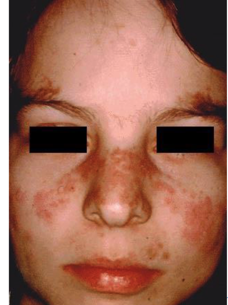 <p>- Early stages non-specific</p><p>- Fever, weight loss, arthritis, fatigue, malaise</p><p>- 40-50% <u>butterfly rash</u> over malar area and nose</p><p><strong>- Kidney involvement in 40-50%</strong></p><p><strong>- Cardiac involvement</strong></p>