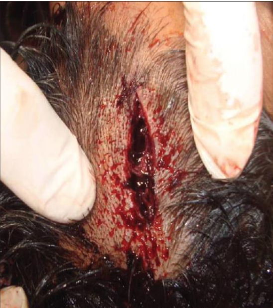 <p><strong>Lacerations:</strong> wounds caused by <strong>blunt force trauma</strong>, producing <strong>tearing of tissue</strong>.</p><p class="isSelectedEnd"><strong>Key features:</strong></p><ul><li><p>Often associated with <strong>abrasions and bruising</strong>; <strong>crushed wound margins</strong>.</p></li><li><p><strong>Messy compared to an incision</strong> (not clean cuts).</p></li><li><p>Types include <strong>tears, splits, grind, stretch, and flap lacerations</strong>.</p></li><li><p><strong>Irregular, ragged edges</strong> with <strong>bridging tissue strands</strong>.</p></li><li><p>Wound openings may appear <strong>linear, Y-shaped, or star-like</strong>.</p></li><li><p><strong>Unilateral undermining</strong> may indicate the <strong>direction of force</strong>.</p></li><li><p><strong>Foreign material may be embedded</strong> in the wound (e.g., glass fragments from a bottle).</p></li><li><p>Usually <strong>do not give a clear impression of the exact force object</strong>.</p></li></ul><p></p>