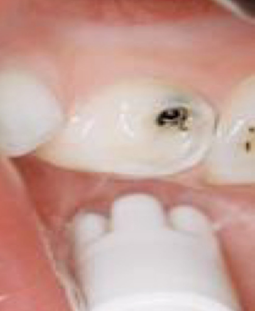 <p>- silver cap turned black</p><p>- healthy gums</p><p>- progression of disease has been arrested</p><p>- cavity remains so we fill it (if baby tooth, leave and will fall out)</p><p>- active cavity (hole)</p><p>- cavity decay (mushy, ashy)</p>