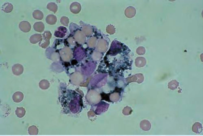 <p><strong><u>Predominant Cells in CSF</u></strong></p><ul><li><p>found <span style="color: red;">with</span><span style="color: yellow;"> RBCs</span> in <span style="color: yellow;">spinal fluid</span></p></li><li><p>may contain <span style="color: red;">phagocytized RBCs</span> (erythrophages) appearing as <span style="color: yellow;">empty vacuoles</span>, hemosiderin granule, etc.</p></li><li><p>increased number indicates<span style="color: red;"> previous hemorrhage</span></p></li></ul><p></p>