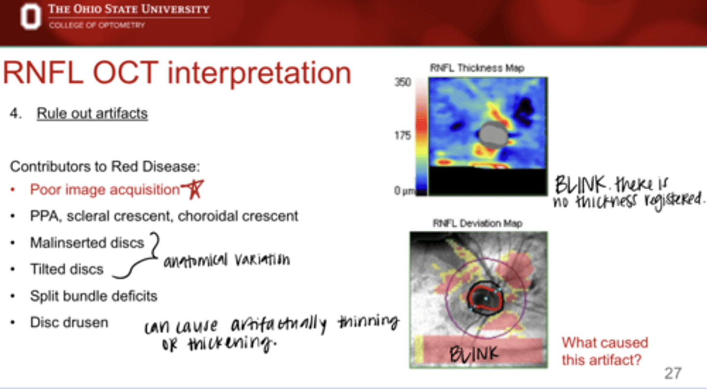 <p>What are contributors of red disease (OCT artifacts)?</p>