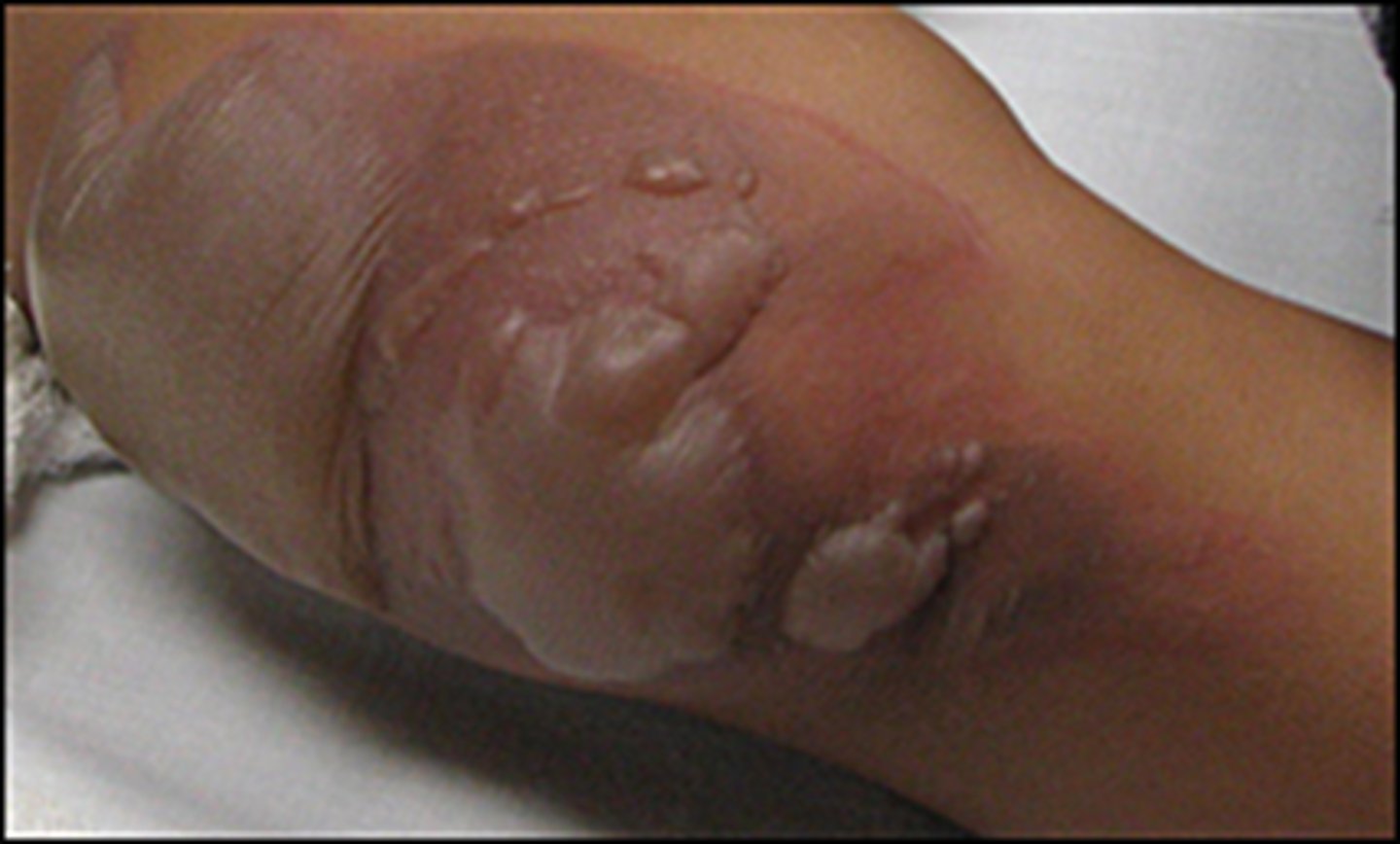 <p>epidermis and upper dermis are damaged, skin is red with blisters</p>