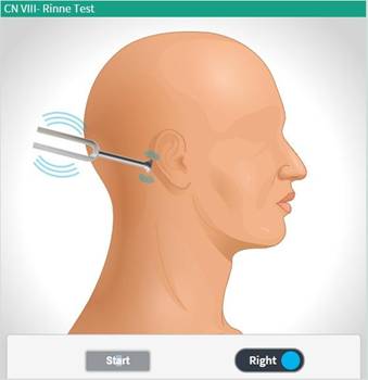 <p>• Compare air conduction and bone conduction</p><p>• Normal: AC > BC</p>
