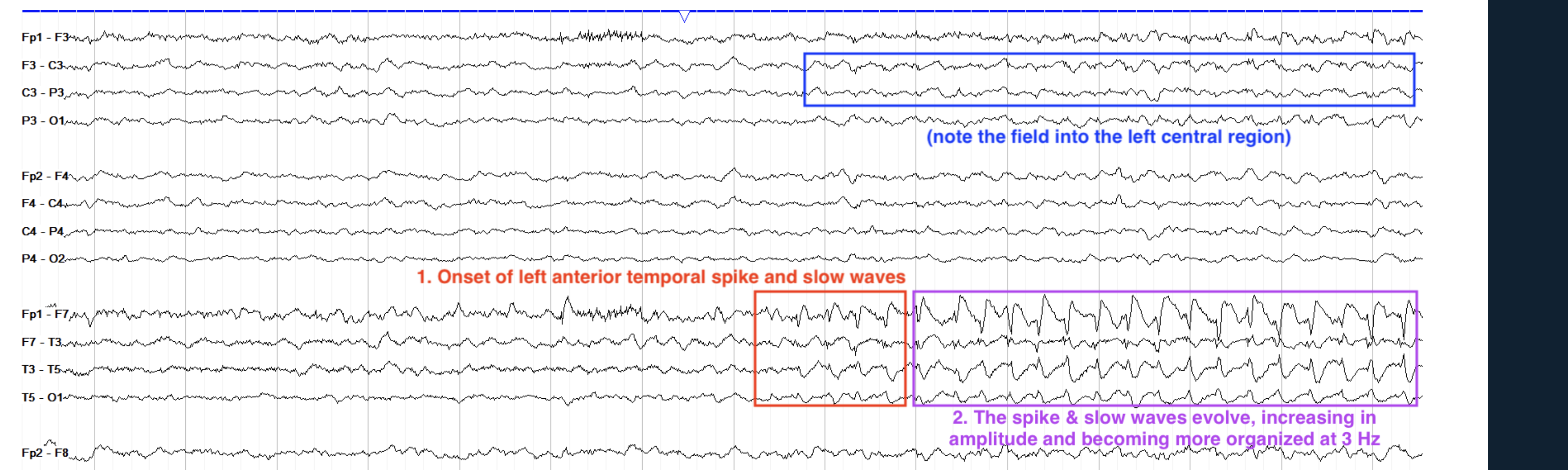 <p>alpha. theta/field left centrtal</p>