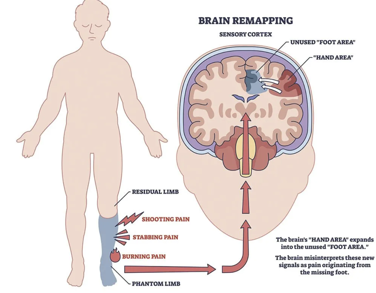 <p>phantom pain </p>