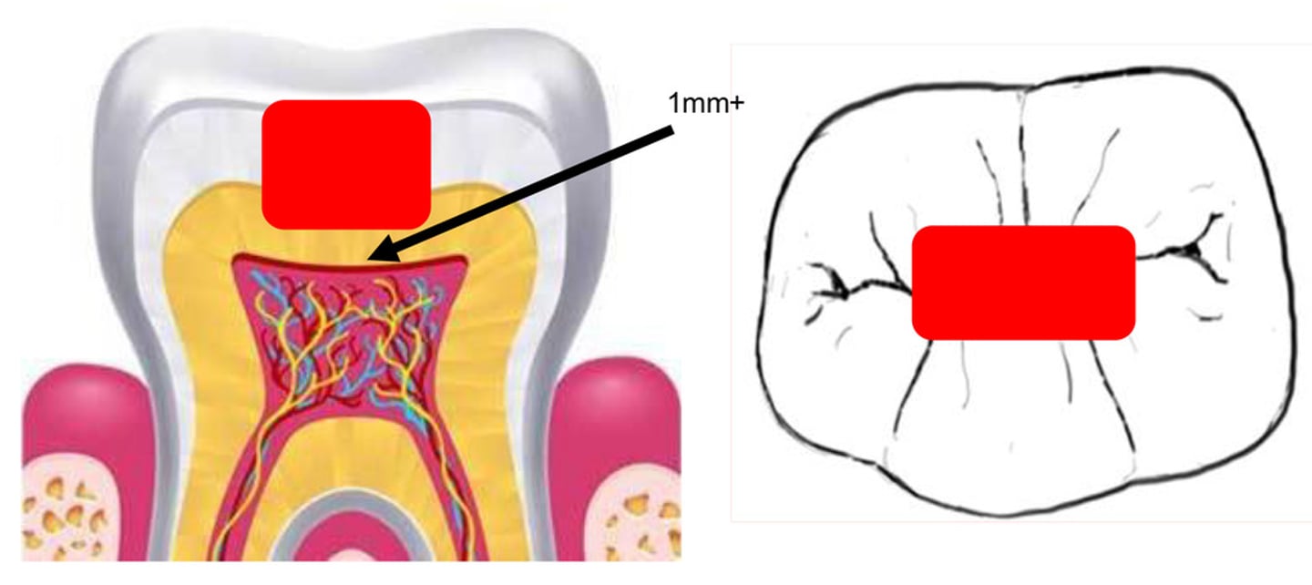 <p>- close to nerve</p><p>- will gain sensitivity</p>