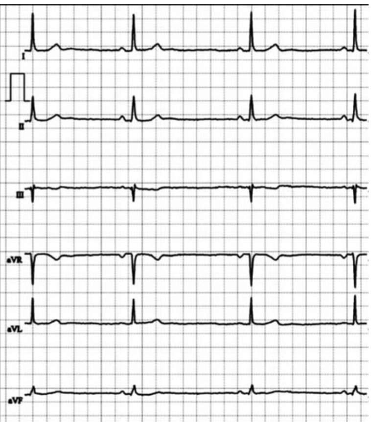 <p>This ECG with prolonged RR intervals in an example of a______________</p><p>(give the definition and features)</p>