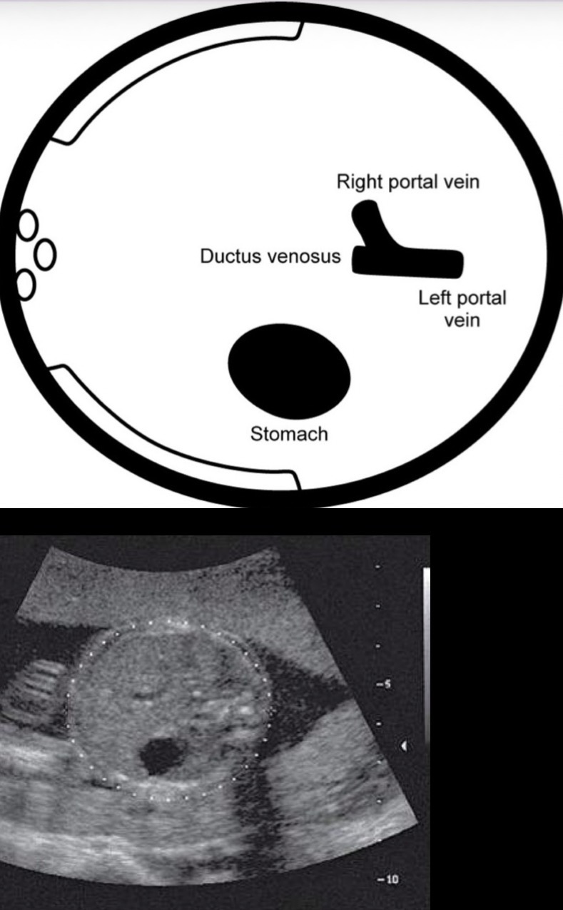 <p>Axial section of fetal abdomen, where umbilical vein branches and right and left portal veins are continuous with one another; elliptical measurement cursor is fit to the skin edge (important to recognize the correct plane of section to obtain accurate and consistent measurements of AC)</p>