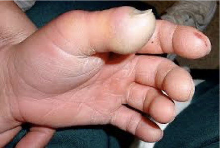 <p>What does this refer to</p><ul><li><p>Throbbing pain in pulp of the finger</p></li><li><p>Fingertip swelling and redness</p></li><li><p>Pain and swelling progressive</p></li><li><p>Tense fingertip pulp</p></li><li><p>Delay in treatment (ORTHO CONSULT)</p><ul><li><p>Can extend toward phalanx (deep)</p></li><li><p>More extensive infection may result in necrosis or involve the palmar tissue/fascia</p></li></ul></li></ul><p></p>
