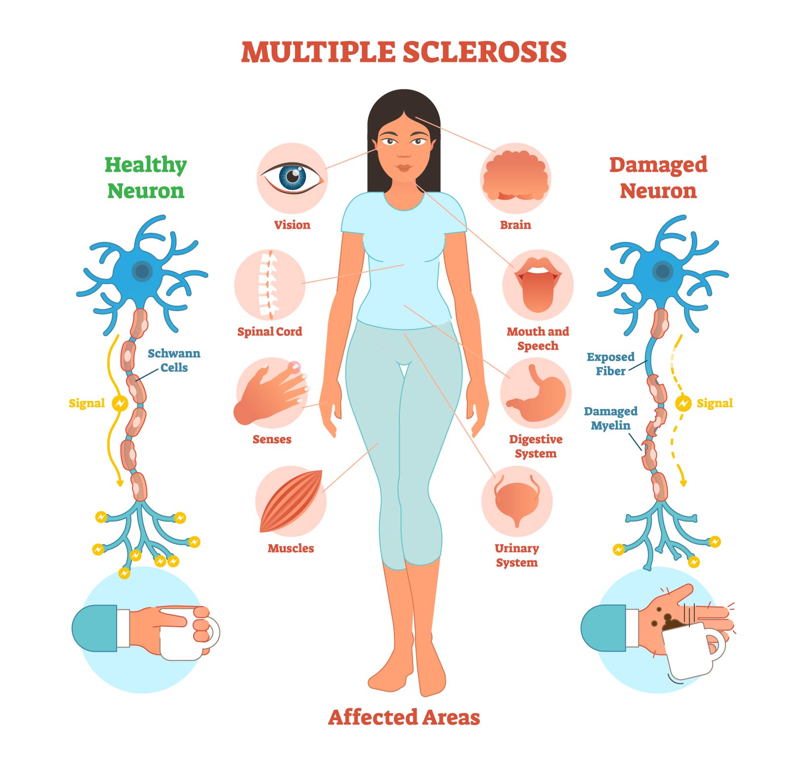 <p>Multiple Sclerosis patho</p>