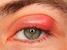 <p>stye!</p><p>Staph infection of the glands</p><p>Erythema, tender nodule on lid</p><p>Warm compresses, topical antibiotics (bactericidal preference!)</p>