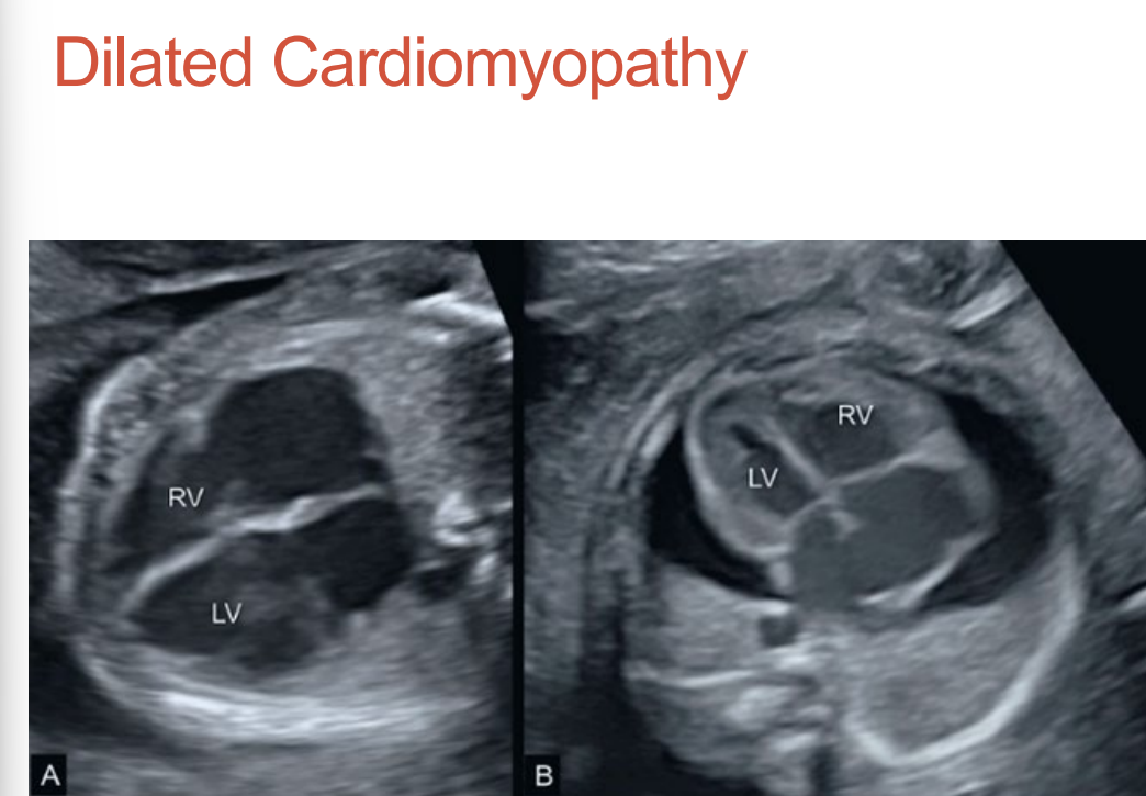 <p>All four chambers dilate •</p><p> Usually has inflow regurgitation • </p><p>Decreased wall contraction • </p><p>Pericardial effusion is a common finding • May lead to hydrops • </p><p>Associated with maternal infections, autoantibodies, parvovirus, and complete heart block</p>