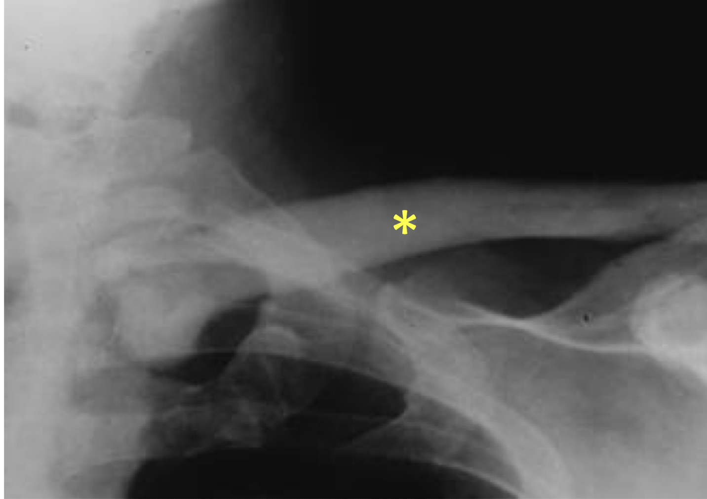 <p>Pagets disease</p><p>Clavicle</p><p></p>
