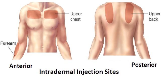 <p>skin of the upper chest, forearms, upper back. ( Can administer)</p>